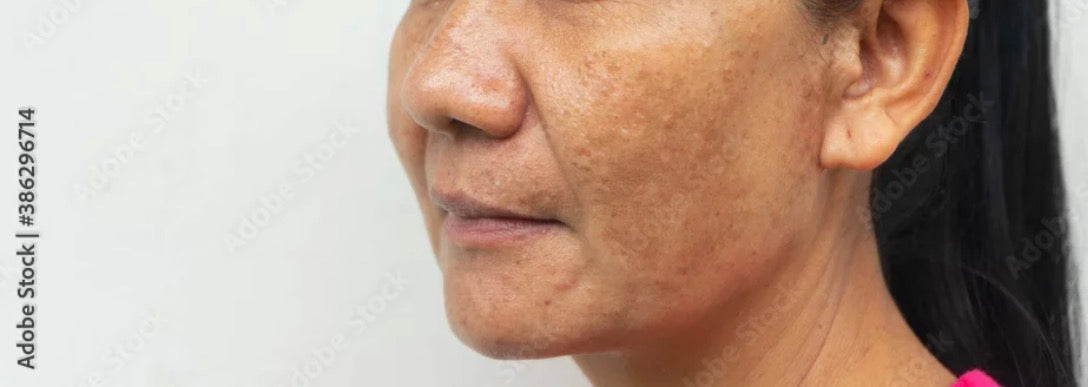 Melasma or hyperpigmentation