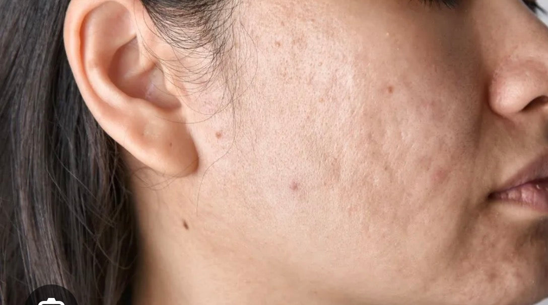 acne marks / post acne.